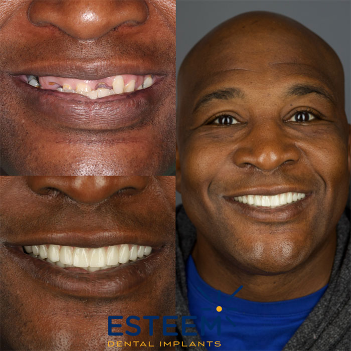 esteem before and after case